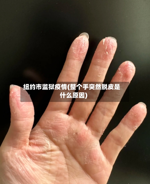 纽约市监狱疫情(整个手突然脱皮是什么原因)