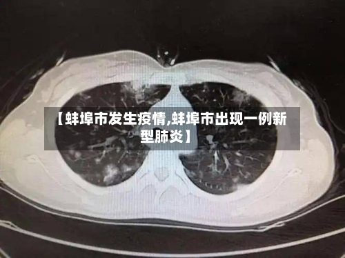 【蚌埠市发生疫情,蚌埠市出现一例新型肺炎】
