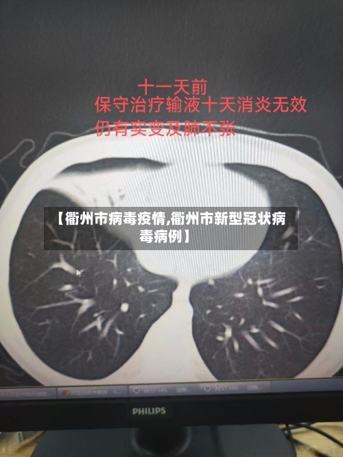 【衢州市病毒疫情,衢州市新型冠状病毒病例】-第2张图片